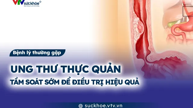 Ung thư thực quản: Tầm soát sớm để điều trị hiệu quả