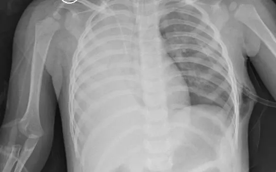 Cứu sống thiếu niên tràn khí màng phổi nặng do vỡ kén khí