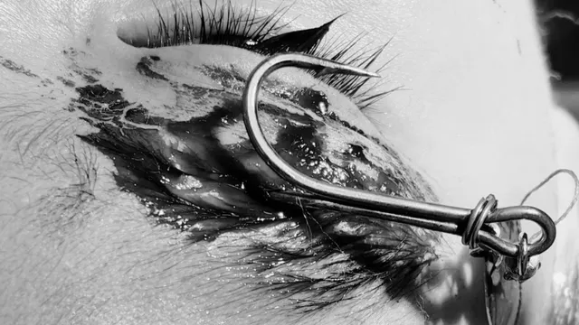 Bé trai 13 tuổi bị móc câu găm trúng vùng mắt phải