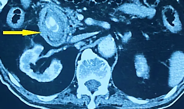 Sỏi túi mật ở người bệnh đái tháo đường: Đừng chủ quan vì nguy cơ biến chứng cao