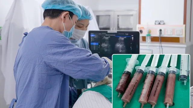 3 lần chọc hút áp xe gan, cứu người đàn ông thoát cửa tử