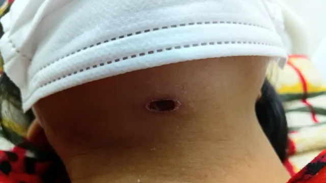 Sốt mò: Tổn thương gan, phổi chỉ từ một vết loét nhỏ