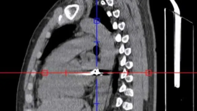 Cứu sống nam bệnh nhân bị đạn bắn xuyên ngực