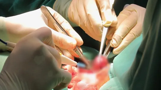 Viêm tuyến giáp mạn tính: Dấu hiệu cần lưu ý