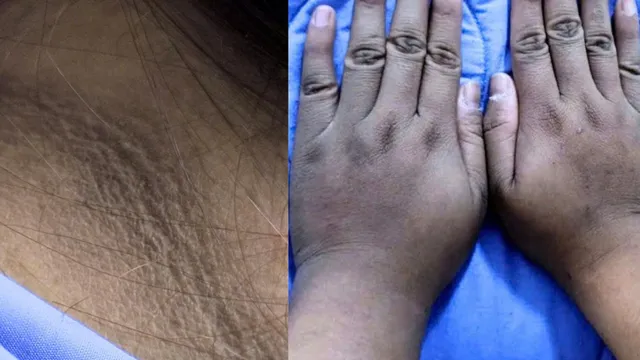 Cô gái 20 tuổi nhập viện vì biến chứng đái tháo đường