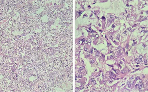 Phát hiện ca ung thư phế quản hiếm gặp