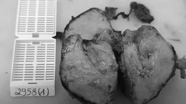 Phát hiện u tuyến ức dù không có triệu chứng