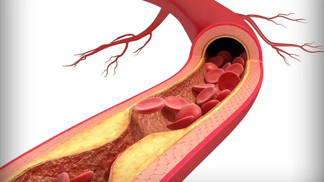 Đừng để xơ vữa mạch máu trở thành "kẻ sát nhân thầm lặng"