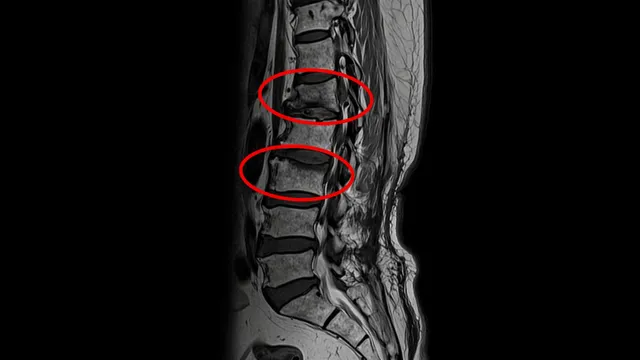 Xẹp 2 đốt sống vì uống thuốc đông y giảm đau xương khớp