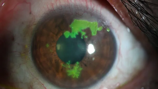 Viêm giác mạc do virus Herpes: Cảnh báo nguy cơ mất thị lực