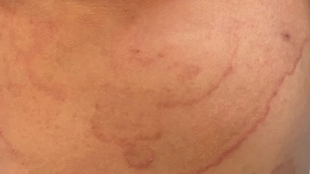 Mùa nắng nóng - thời điểm nấm da dễ bùng phát