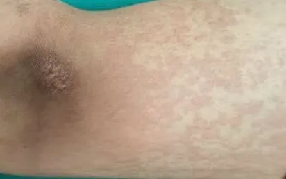 Nam sinh 17 tuổi nhập viện cấp cứu sau khi ăn ve sầu