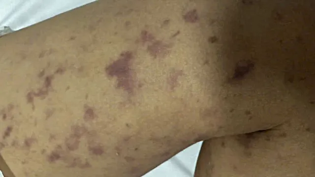 2 ca mắc não mô cầu, 1 trẻ đã tử vong tại Đắk Lắk