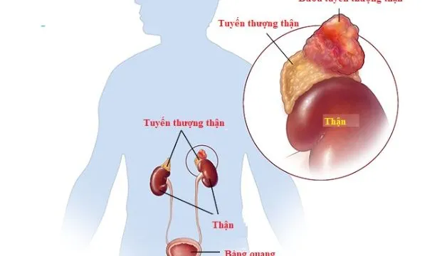 U tuyến thượng thận: Khối u nhỏ, hậu quả khó lường