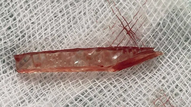 Cứu sống bé 11 tuổi bị mảnh kính đâm thủng ruột