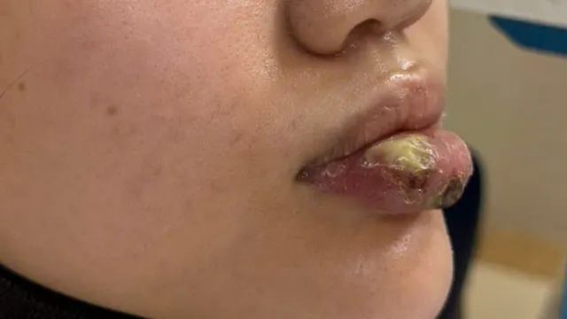 Nhiễm trùng nặng sau tiêm "giải filler"
