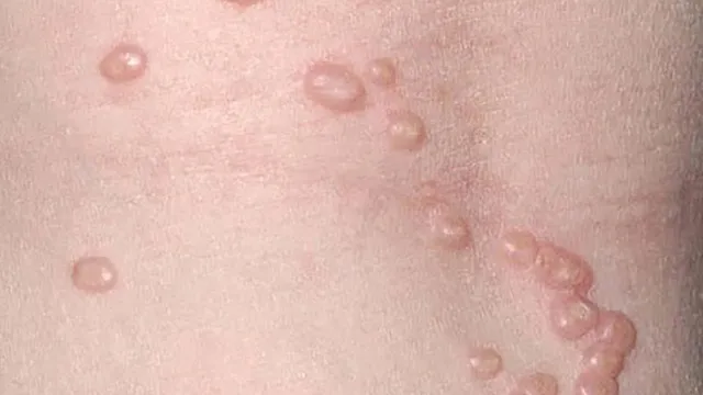 Cẩn trọng với u mềm lây ở trẻ em 