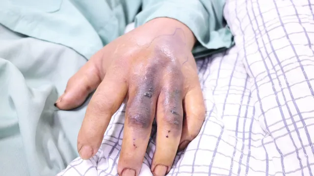 Cảnh báo nguy cơ rắn độc cắn mùa hè