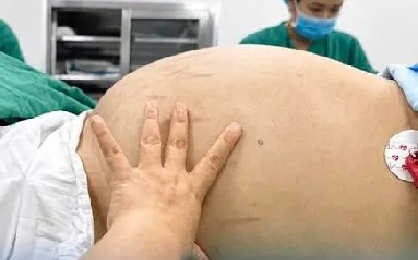 Cắt khối u buồng trứng khổng lồ chứa 10 lít dịch ở bệnh nhân nữ trẻ tuổi