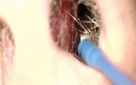 Pin cúc áo mắc trong mũi trẻ suốt một tháng