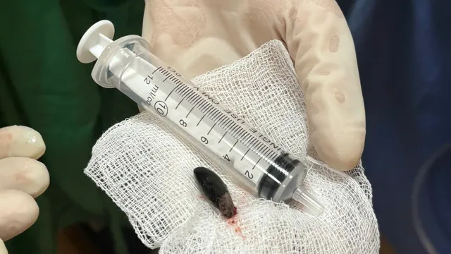 Suýt xẹp phổi vì hóc hạt hồng xiêm