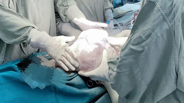 Mang khối u buồng trứng gần 8kg ở tuổi 82