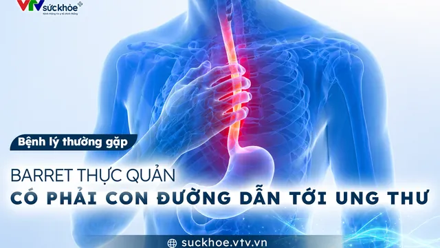 Barret thực quản có phải con đường dẫn tới ung thư?