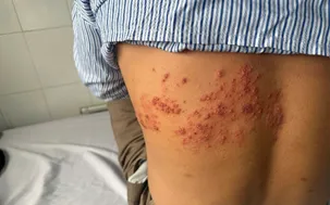 Chủ quan với zona, người đàn ông gặp biến chứng nặng