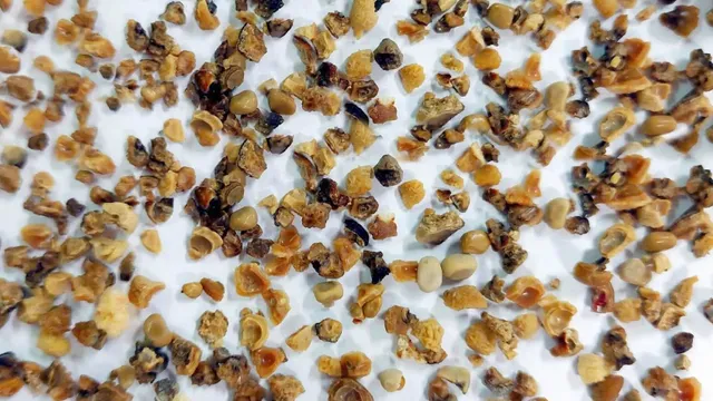 Đau âm ỉ vùng thắt lưng, cụ ông phát hiện sỏi thận kích thước lớn