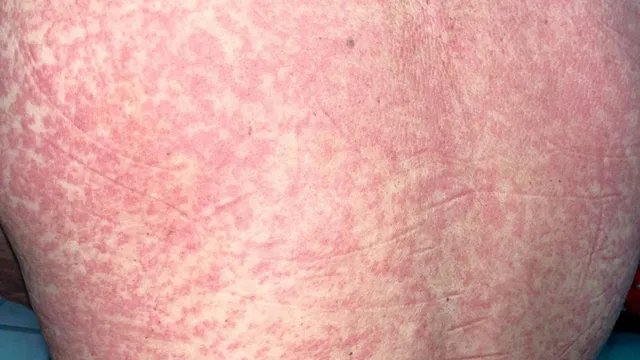 Ban đỏ da tưởng dị ứng, hóa ra nhiễm liên cầu khuẩn
