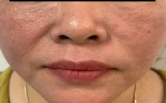 Viêm da tiếp xúc dị ứng vùng mặt do mỹ phẩm