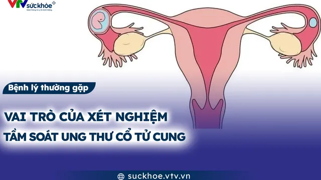 Vai trò của xét nghiệm tầm soát ung thư cổ tử cung