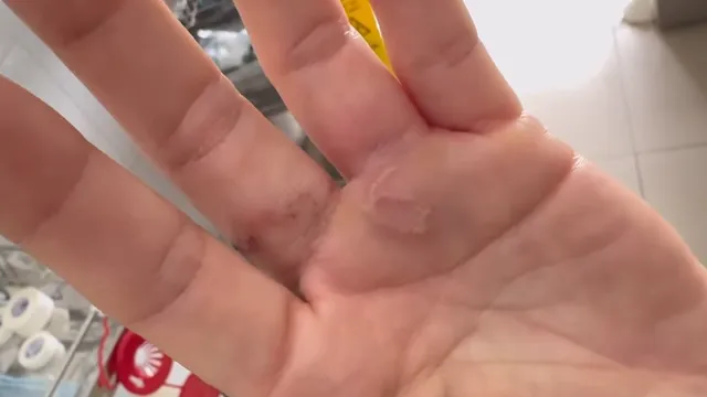 Mùa mưa, cảnh giác nguy cơ nhiễm ký sinh trùng, giun sán