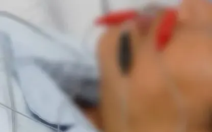 Đột ngột méo miệng, lệch mặt: Cảnh giác nguy cơ đột quỵ