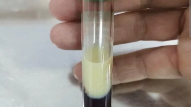 Cảnh báo nguy cơ biến chứng từ tình trạng tăng mỡ máu nặng