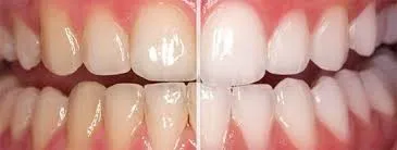 Vàng răng: Nguyên nhân, phân loại và cách khắc phục hiệu quả Vàng răng: Nguyên nhân, phân loại và cách khắc phục hiệu quả
