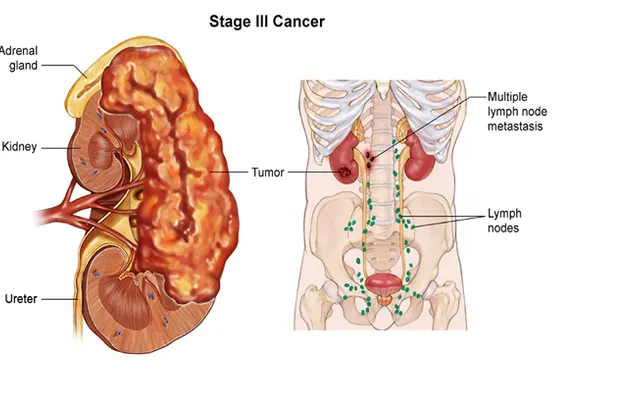 Những điều cần biết về ung thư thận | VTV.VN