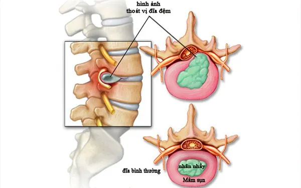 Thoát Vị Đĩa Đệm Sự Thật Cần Biết - Triệu chứng và biến chứng của thoát vị đĩa đệm