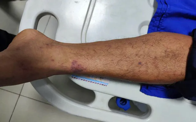 Tăng cường giám sát bệnh não mô cầu tại phía Nam