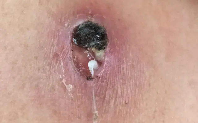 Phát hiện một ca mắc giun rồng tại Phú Thọ