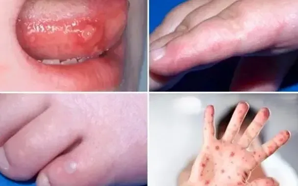 TP Hồ Chí Minh: Ca mắc tay chân miệng tăng trở lại trong tuần 18