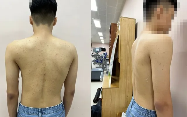 Khám miễn phí gù, vẹo cột sống cho trẻ dưới 18 tuổi