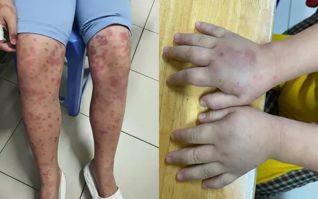 Cẩn trọng với ban xuất huyết Schonlein- Henoch ở trẻ