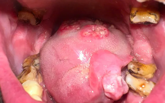 Ung thư khoang miệng: Các biểu hiện ban đầu thường gặp