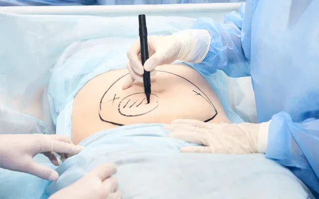 Yêu cầu Bệnh viện Đa khoa Gia Định tạm ngưng phẫu thuật hút mỡ bụng