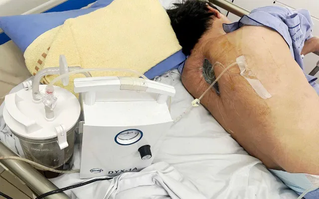 Thoát liệt nhờ phát hiện nhiễm nấm tại vết mổ cột sống ngực