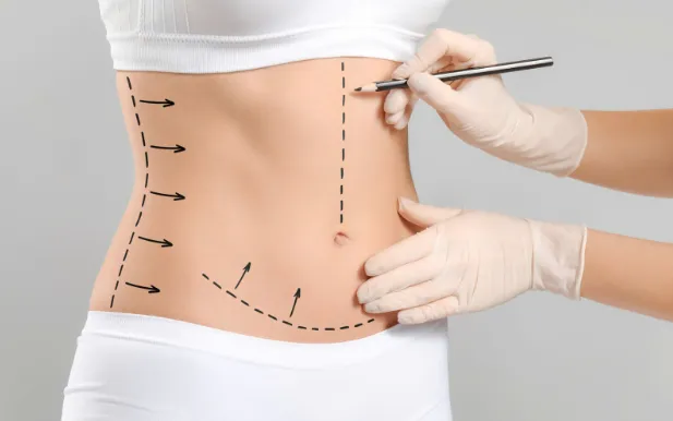 Hút mỡ siết eo 3 điểm - Bí quyết sở hữu vòng eo "con kiến"