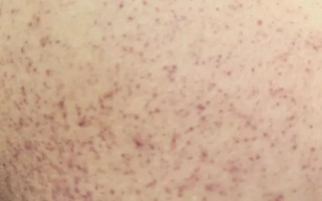 Cô gái 21 tuổi suýt mất mạng vì sốc sốt xuất huyết Dengue nặng