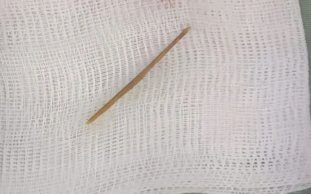 Bé trai đau bụng kéo dài do cây tăm xuyên thủng tá tràng