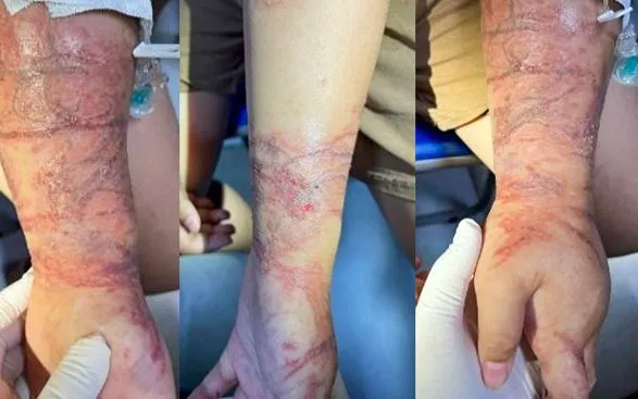 Cảnh báo mùa du lịch biển: Viêm da tiếp xúc do sứa biển